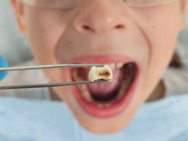 Best Emergency Tooth Extraction in Linntown, PA
